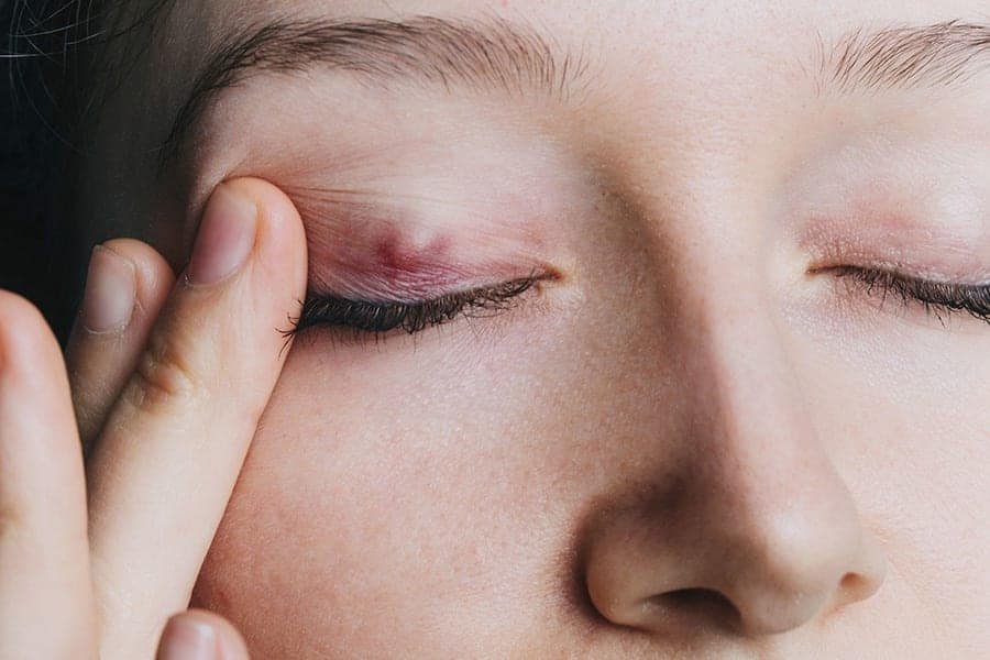 Le cancer des paupières : la majorité des cas sont peu agressifs